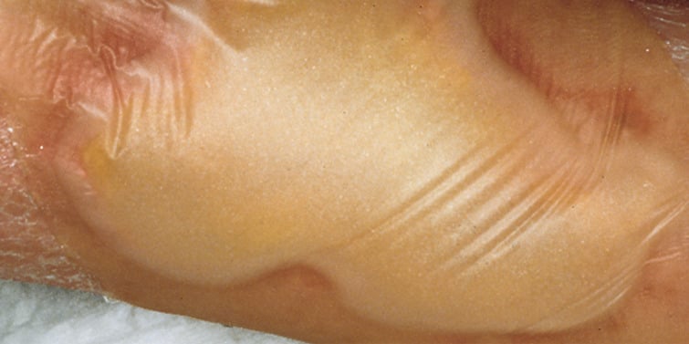 Hydrocoll® 2 Sacral